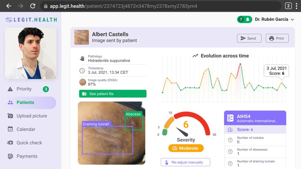 Hidradenitis supurativa severity
measure