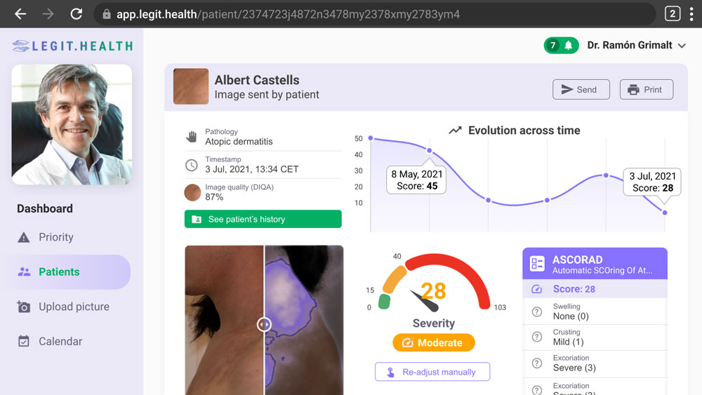 ASCORAD, la nouvelle génération du système de notation automatique de la dermatite atopique
