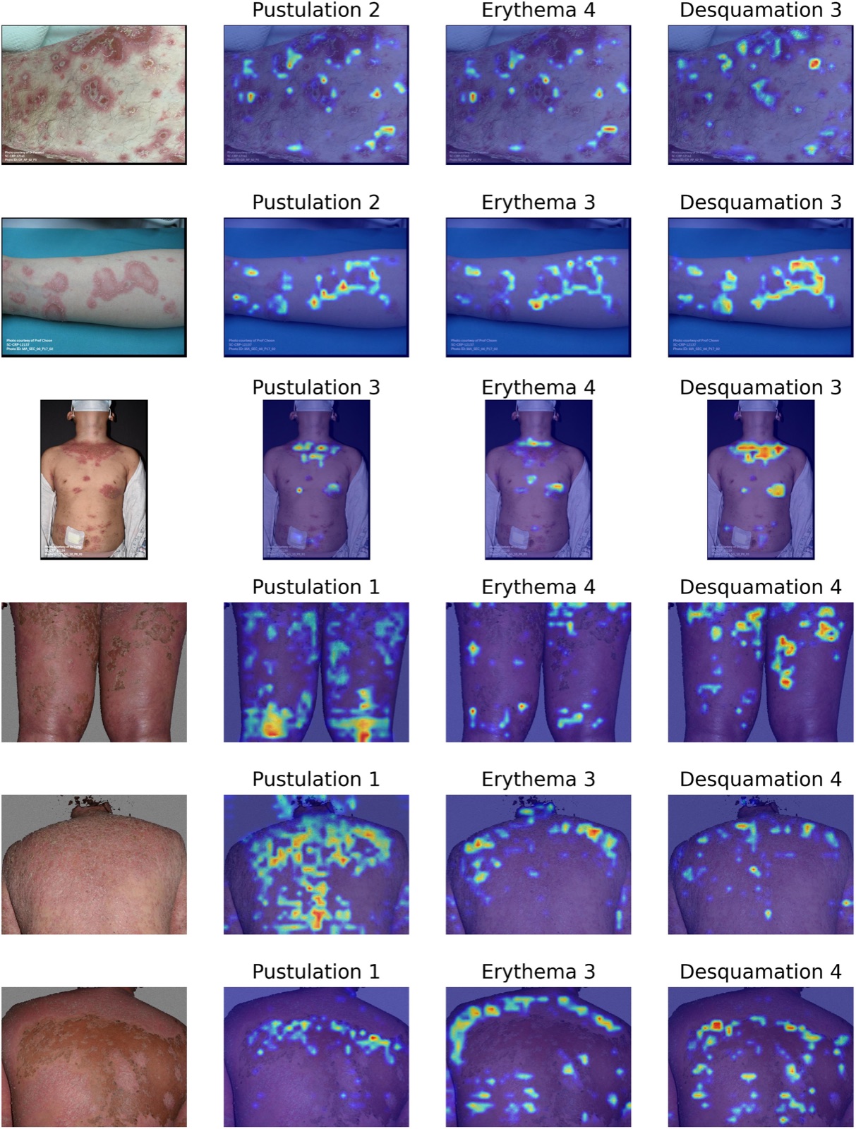Grille de six images cliniques de psoriasis pustuleux généralisé, chacune suivie de trois cartes de chaleur montrant les zones de l'image sur lesquelles le modèle s'appuie pour coter la pustulation, l'érythème et la desquamation