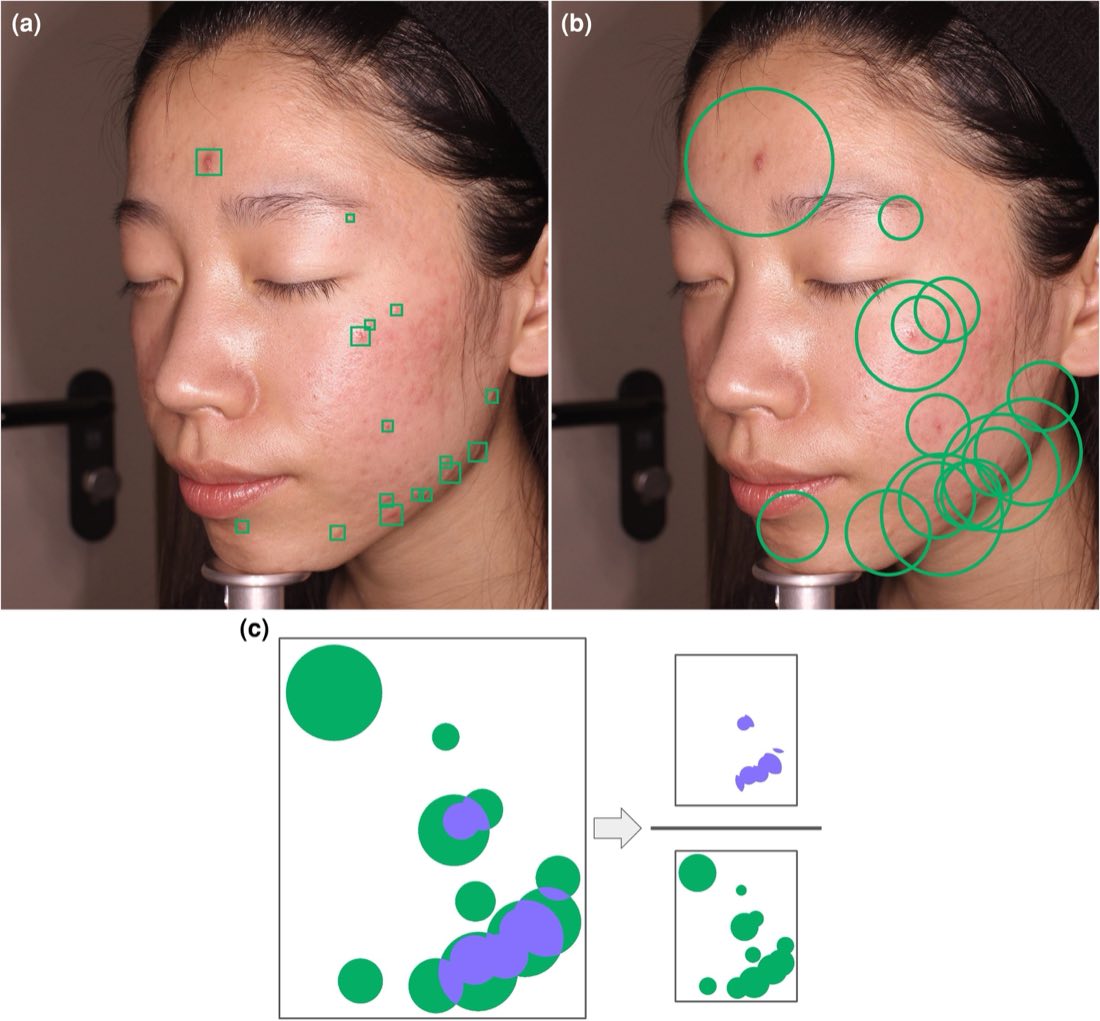 Three-panel figure showing automatic acne assessment on a facial image: detected inflammatory lesions, their influence areas, and the resulting density calculation