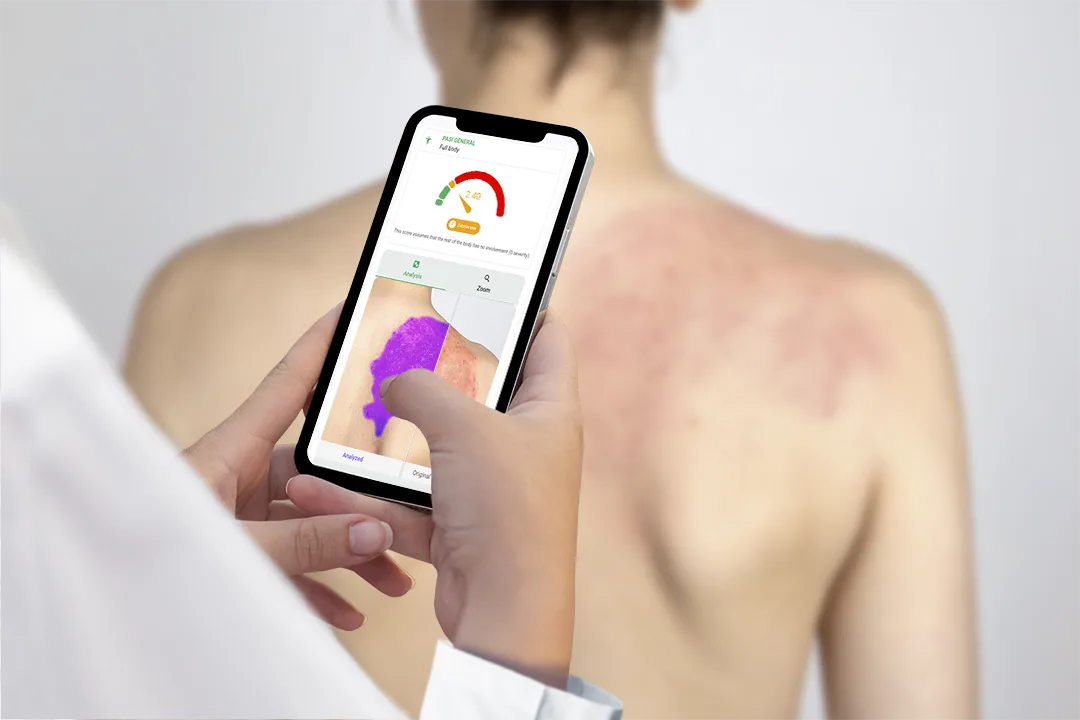Evaluación automática de la gravedad de la psoriasis en la espalda de un paciente