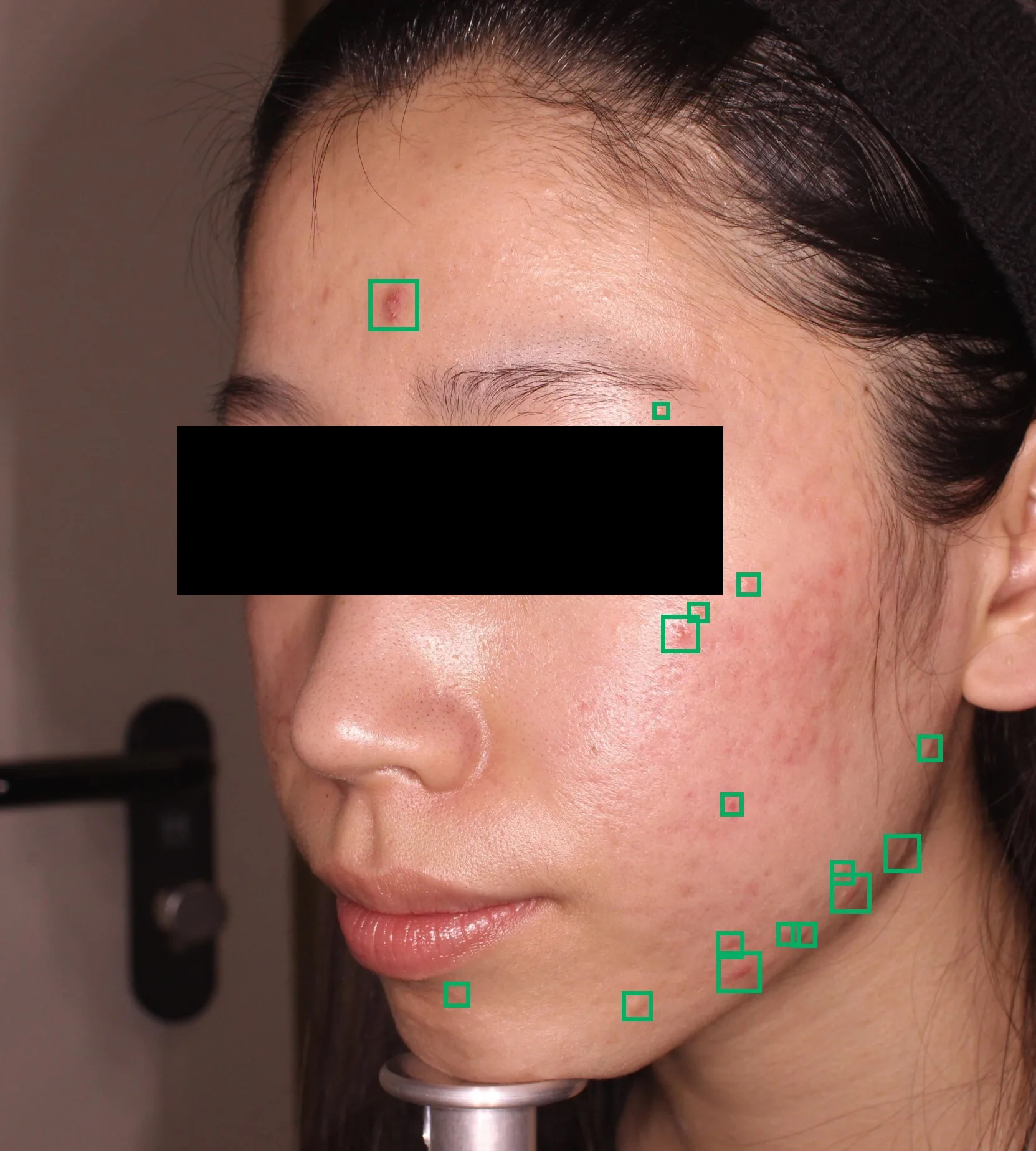 Bounding boxes identifying inflammatory acne lesions