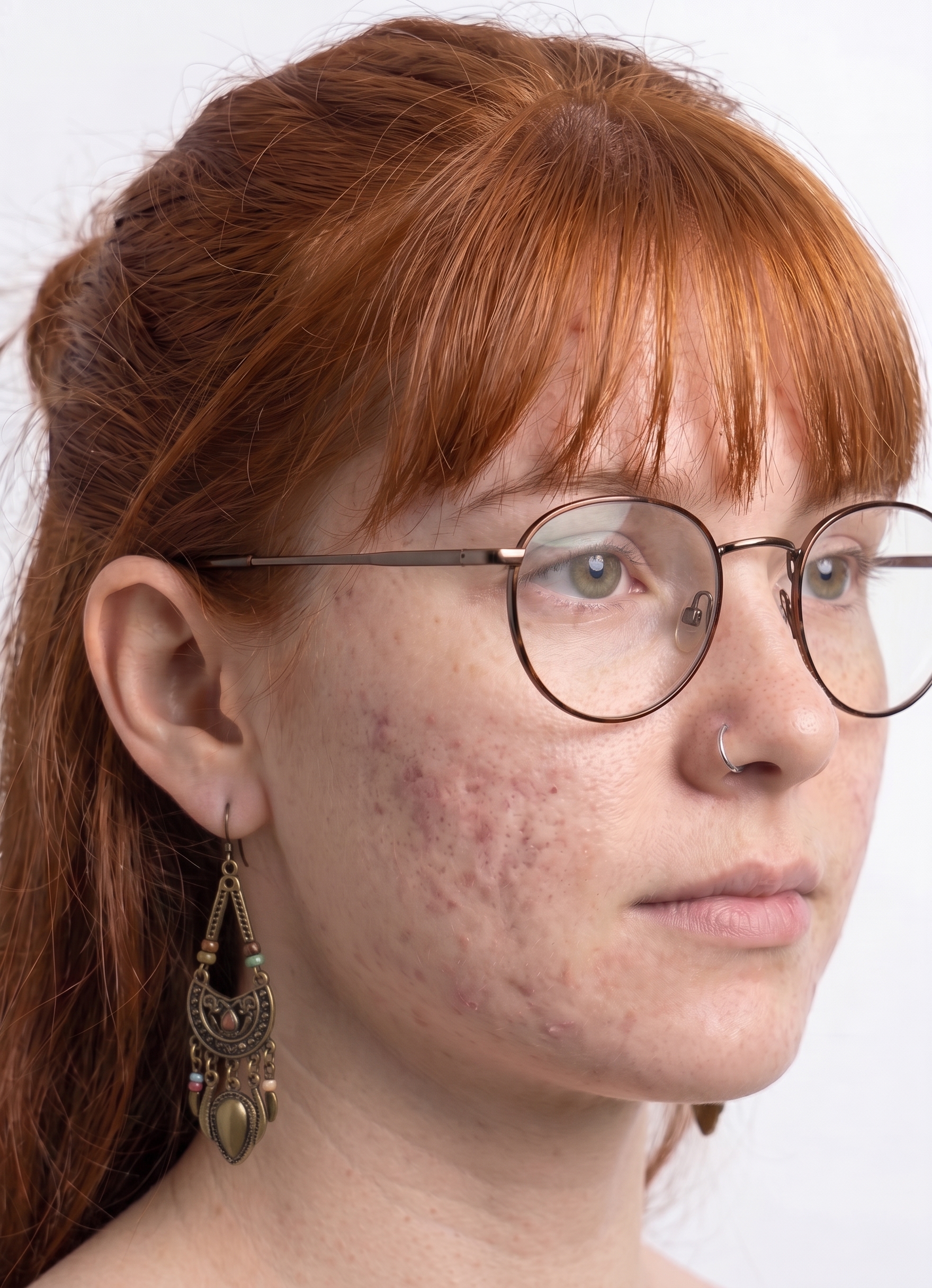 Diagonal view of a face with acne, with a fringe over the forehead, glasses, a nose piercing and an earring