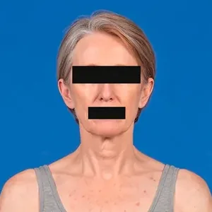 Face anonymised with black bands over the eyes and the mouth