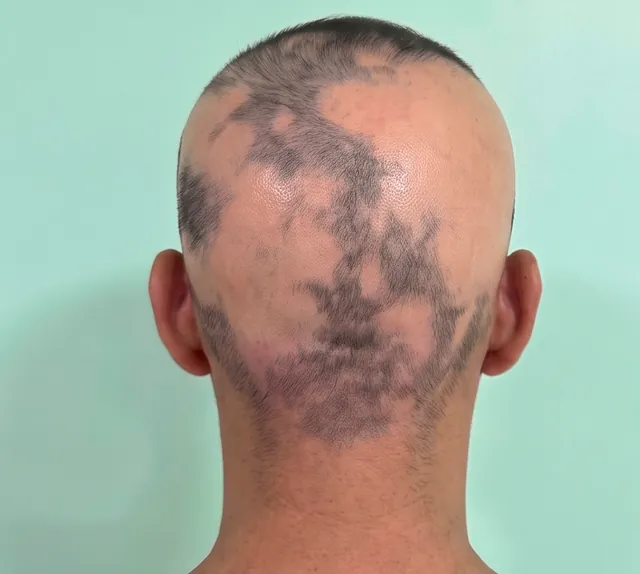 Back of the scalp, captured following the standard protocol