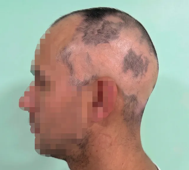 Left side of the scalp, captured following the standard protocol