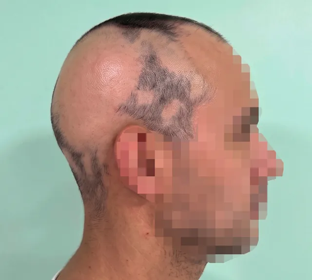 Right side of the scalp, captured following the standard protocol