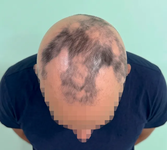 Top of the scalp
