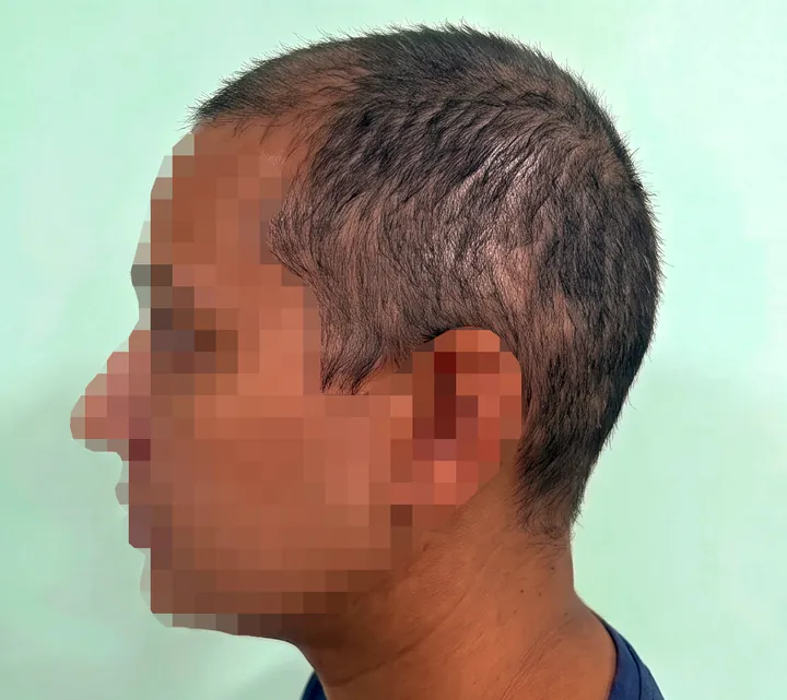 Left side of the scalp at week 36