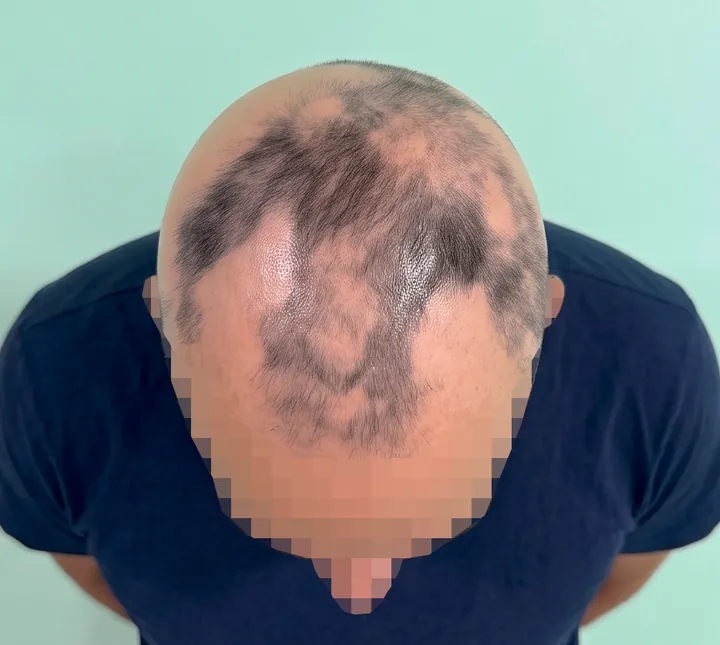 The same top view under even light, with the whole scalp in frame