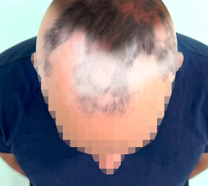 Top view of the scalp under harsh direct light, washed out and too close to the camera