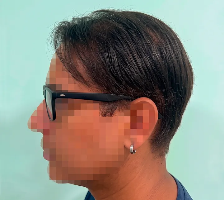 Side view with the hair combed over the areas of hair loss, glasses and an earring