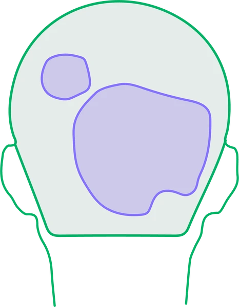 Back of the scalp: hair-bearing scalp with patches of hair loss