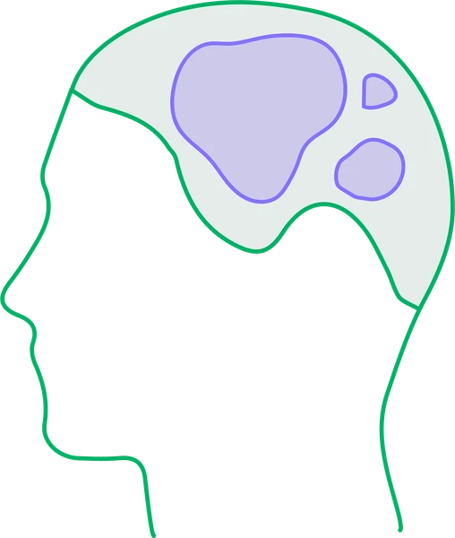 Left side of the scalp: hair-bearing scalp with patches of hair loss