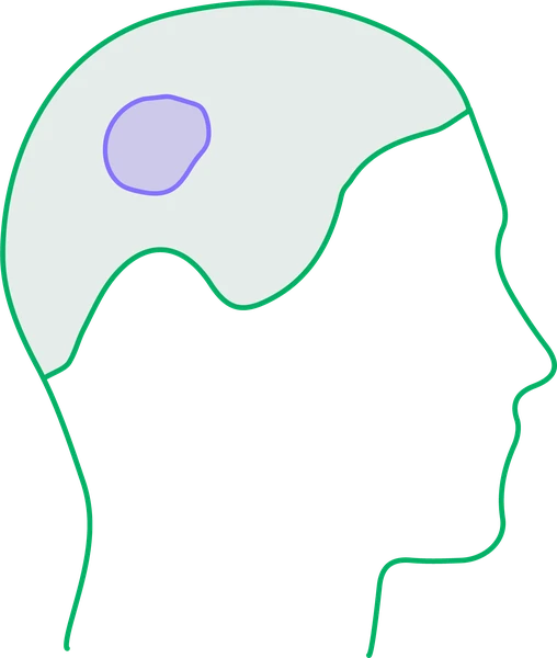 Right side of the scalp: hair-bearing scalp with patches of hair loss