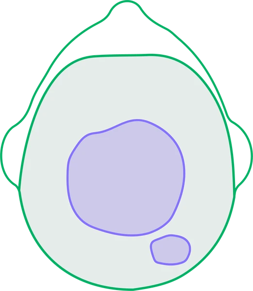 Top of the scalp: hair-bearing scalp with patches of hair loss