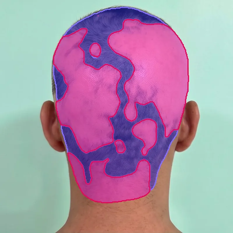 The same photograph with hair segmented in violet and hair loss in pink