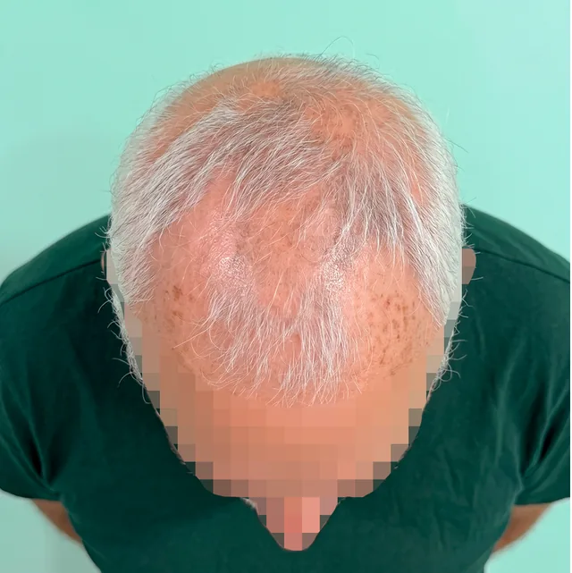 Top of the scalp