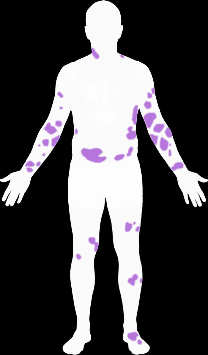 AI segmentation output: eczema-affected areas detected and mapped onto a body silhouette
