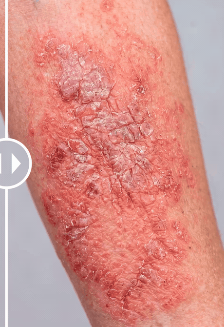 Automated analysis of an atopic dermatitis lesion, showing the transition from photograph to pixel-level segmentation