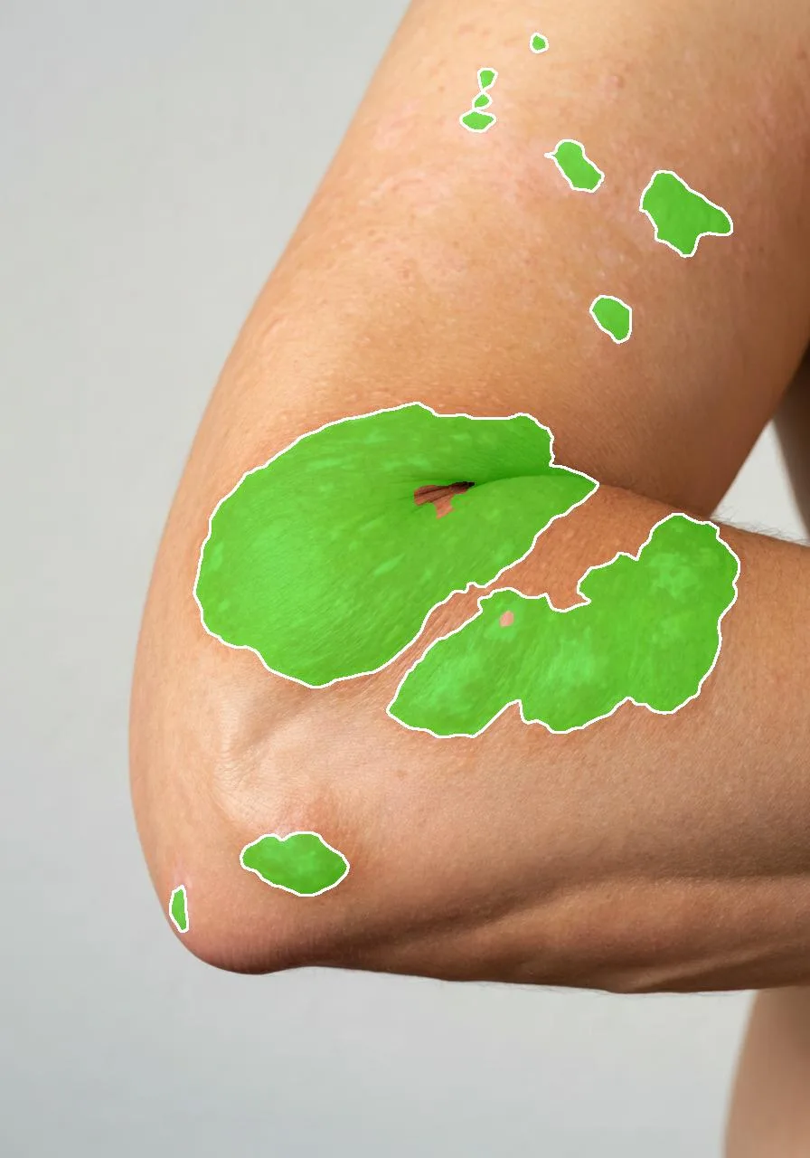 Baseline visit: AI erythema segmentation of a severe flexural atopic dermatitis flare
