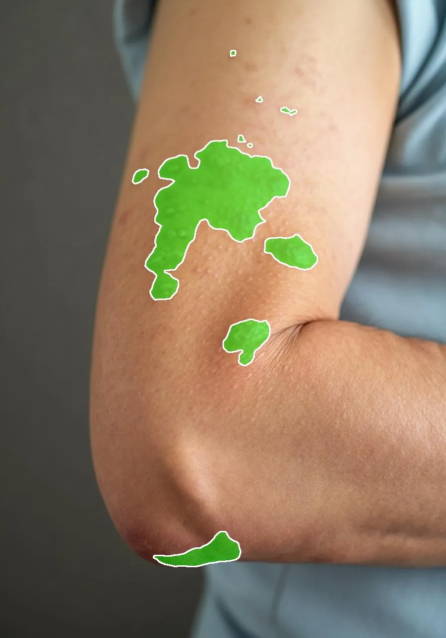 Follow-up visit: AI erythema segmentation showing a reduced affected area after treatment