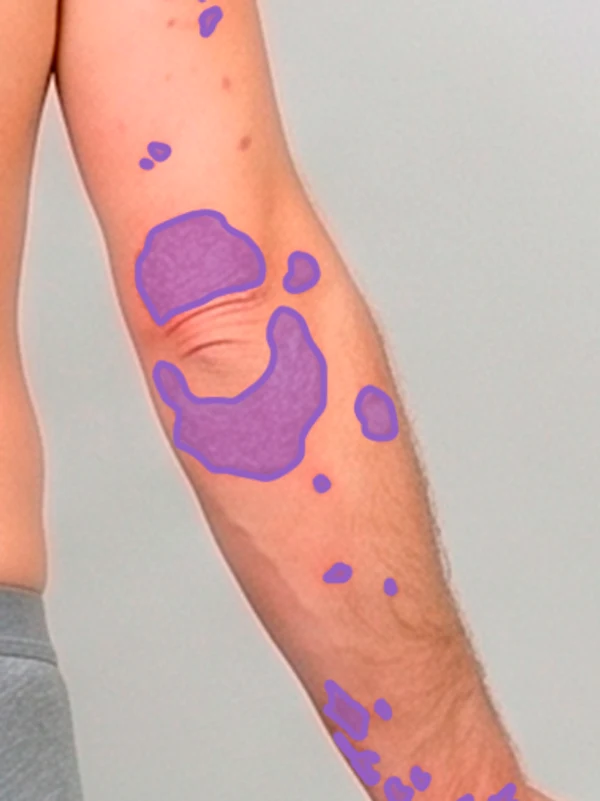 AI segmentation: Upper extremities