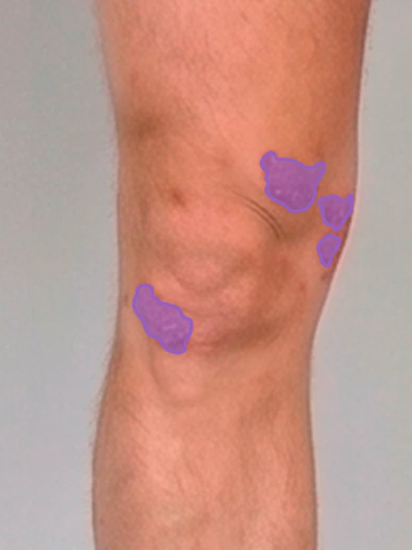 AI segmentation: Lower extremities