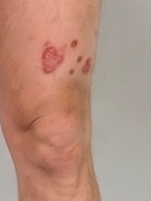 Close-up of atopic dermatitis plaques on the knee