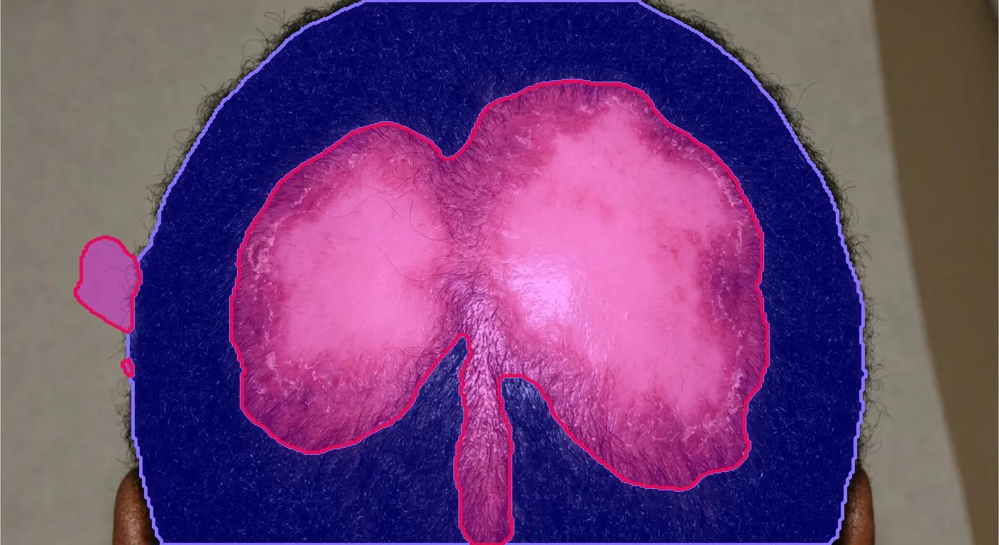 AI segmentation: Scalp