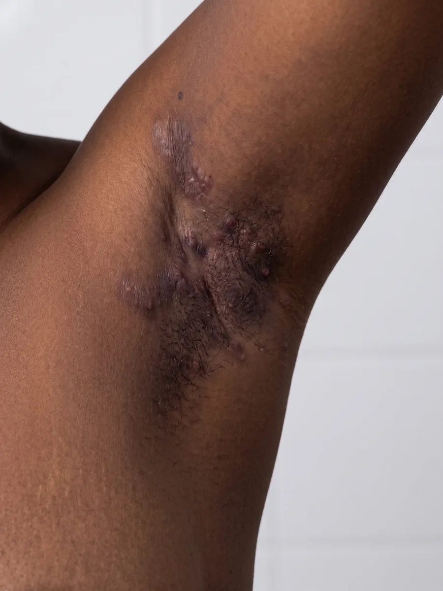 Original photograph of an axilla with hidradenitis suppurativa