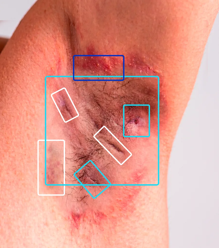The same axilla with a bounding box around each lesion detected by the AI