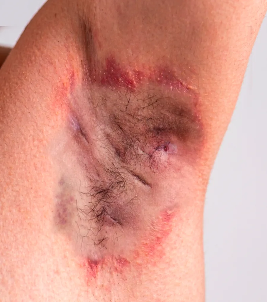 Axilla with hidradenitis suppurativa, original photograph