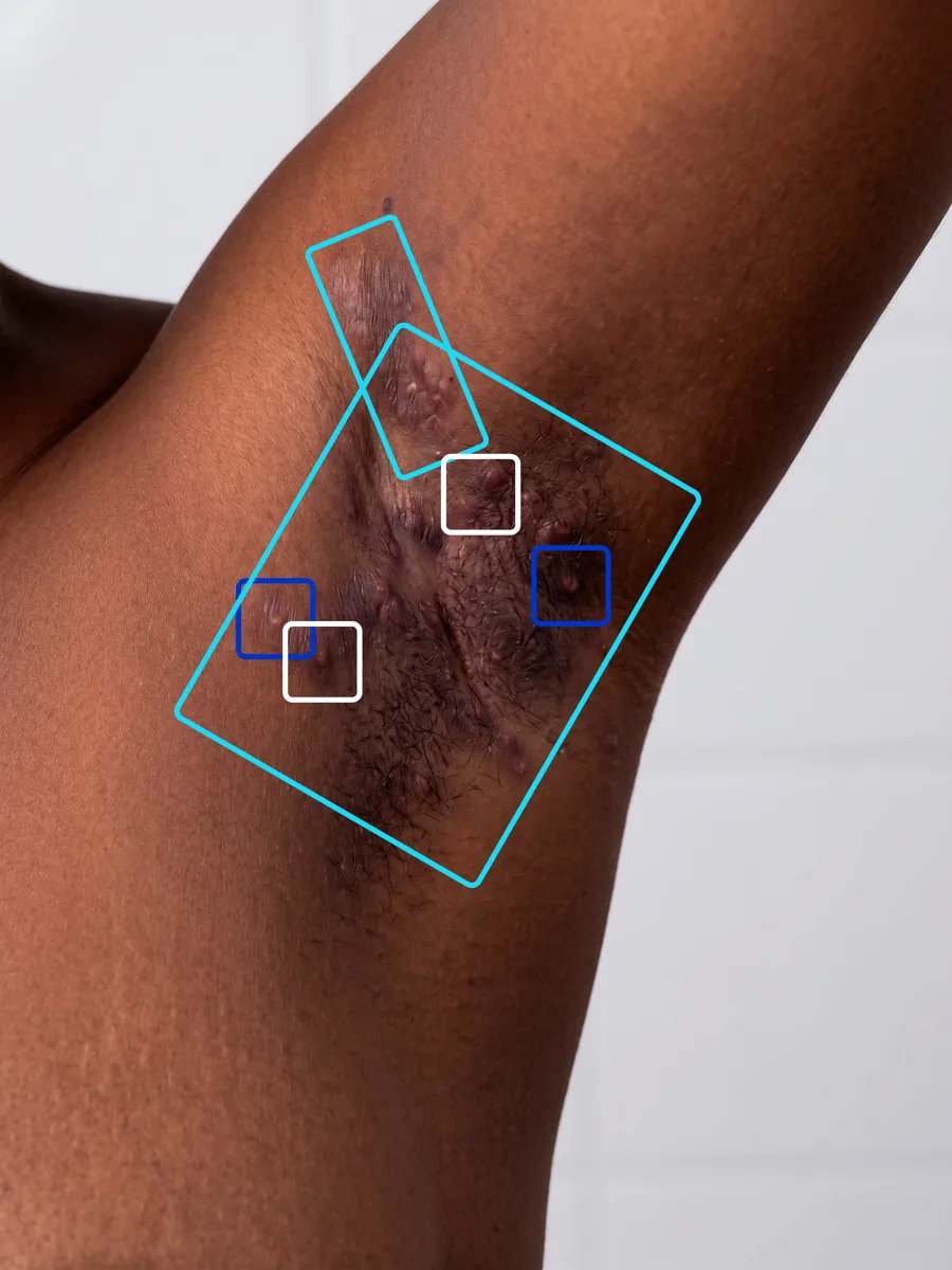 The same axilla after the investigator's review, with one additional lesion annotated