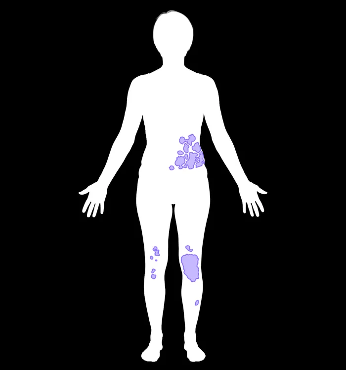 AI segmentation output: affected areas detected and mapped onto a body silhouette