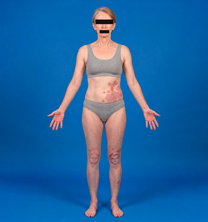 Full-body photograph of a patient with psoriasis before segmentation