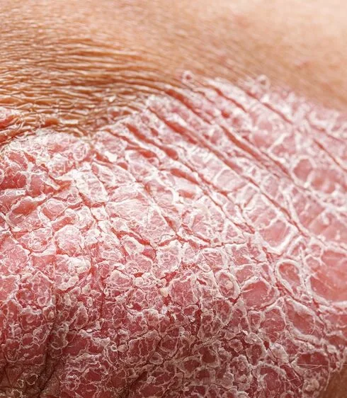 Close-up of a plaque, leg region