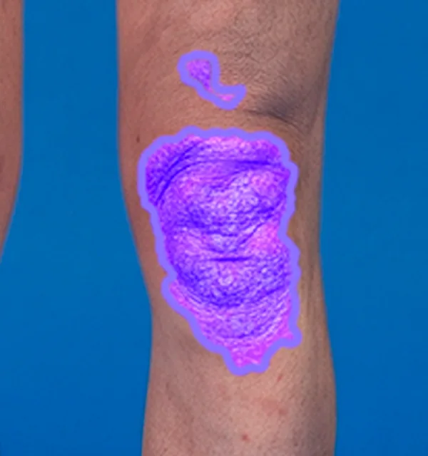 AI segmentation: Lower extremities