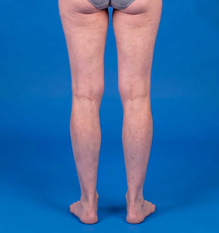 Back view of the legs with psoriasis plaques