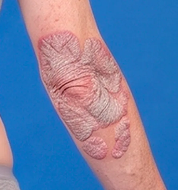 Close-up of a psoriasis plaque on the elbow and forearm