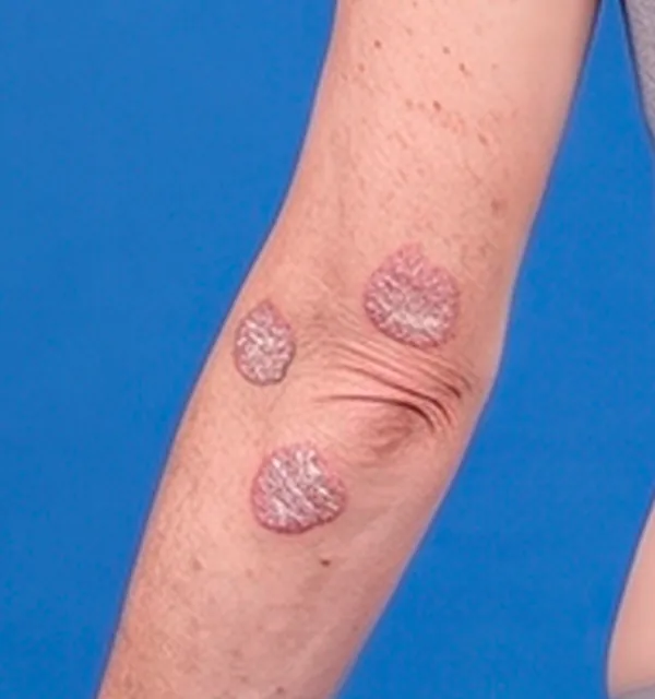 Close-up of psoriasis plaques on the forearm