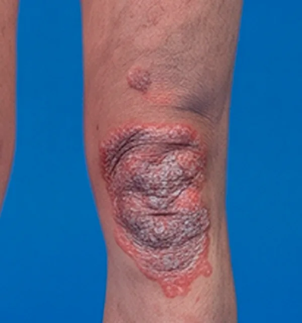 Close-up of a psoriasis plaque on the knee