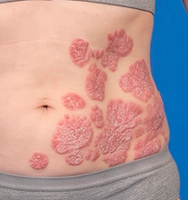 Close-up of confluent psoriasis plaques on the abdomen