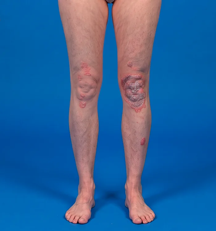 Front view of the legs with psoriasis plaques