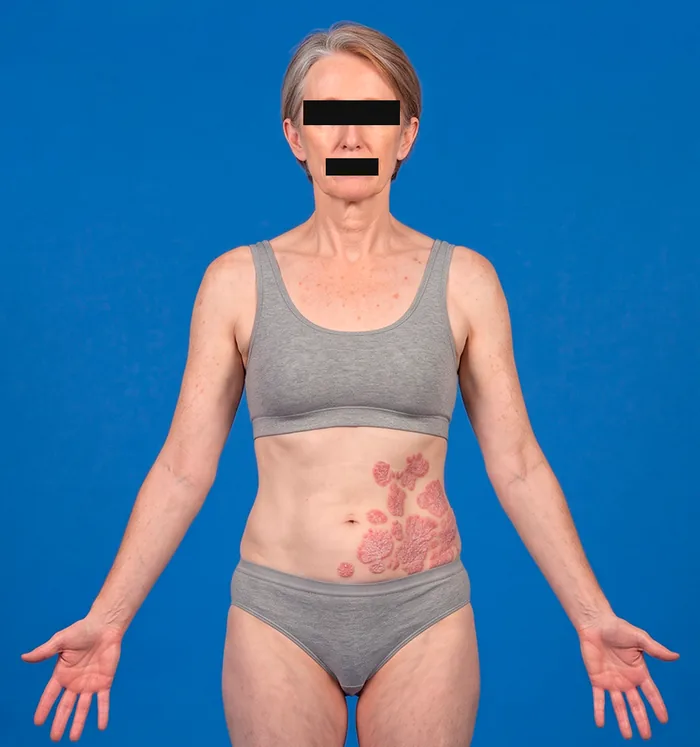 Front view of the head and trunk with psoriasis plaques