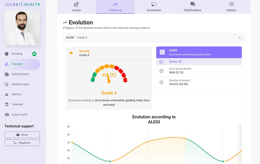 severity of acne with scoring system