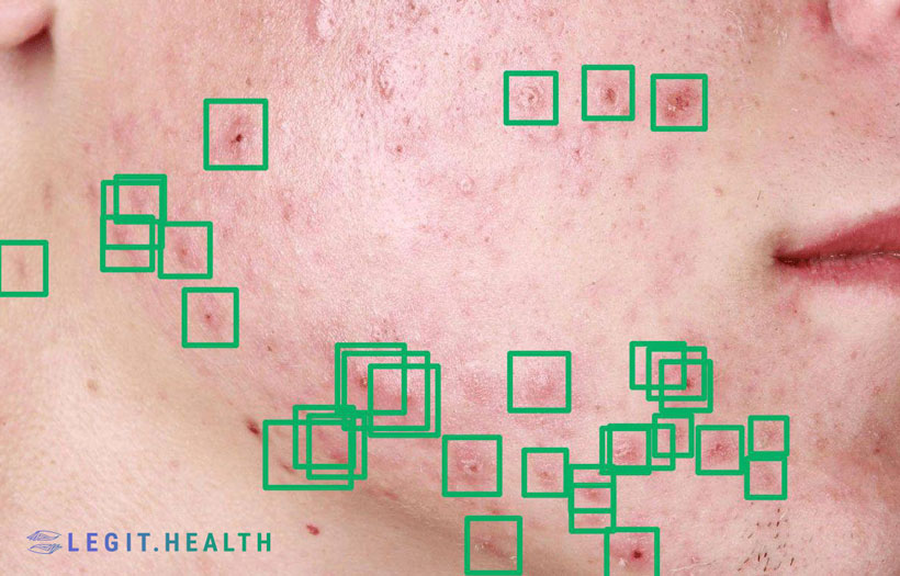 ALEGI Acne scoring system